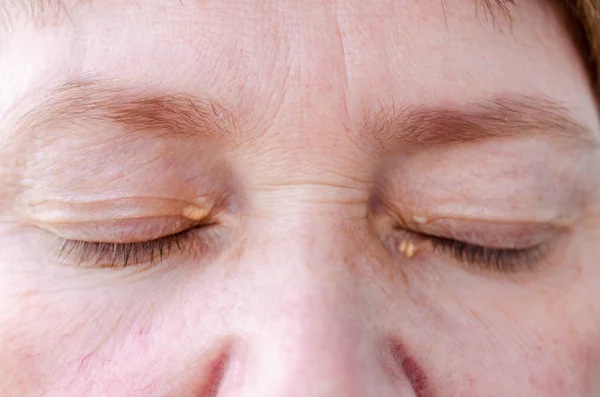 V důsledku poruch v lipidním metabolismu se ženy s malými vrchy chvějí na oční víčka. Problém medicíny a kosmetologie. — Stock fotografie