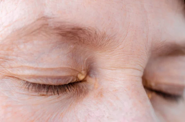 Frauen Augenlider mit kleinen Wucherungen aufgrund von Störungen des Fettstoffwechsels. medizinisches und kosmetologisches Problem. — Stockfoto