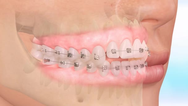 Närbild av tand modell med hängslen. Tandstruktur korrigering — Stockvideo