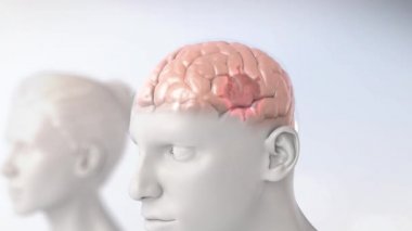 Beyin Tümörü Biyolojisinde Kanser Kök Hücreleri