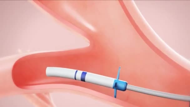 Endoprothèses au poumon animation 3D — Video