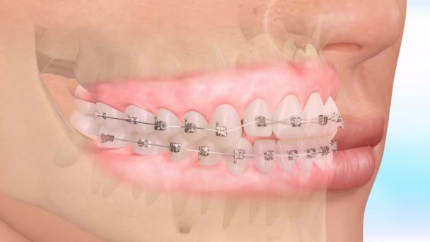 Κοντινό στο Οδοντιατρικό μοντέλο με σιδεράκια. Διόρθωση της δομής των δοντιών — Αρχείο Βίντεο