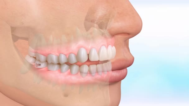 Крупним планом стоматологічна модель з брекетами. Корекція структури зуба — стокове відео