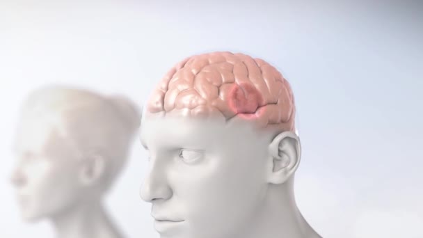 Ένας κακοήθης όγκος του μυικού ιστού του νευρικού συστήματος. — Αρχείο Βίντεο