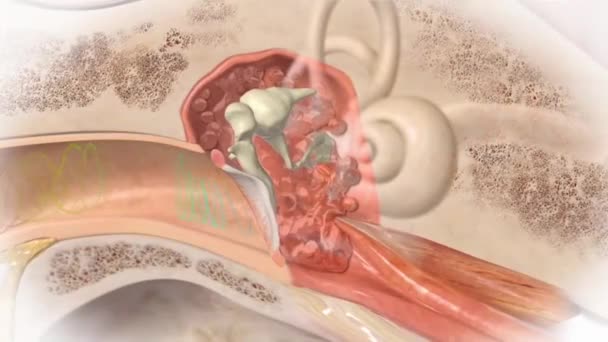 Animation médicale 3D de perte auditive, anatomie intra-auriculaire — Video