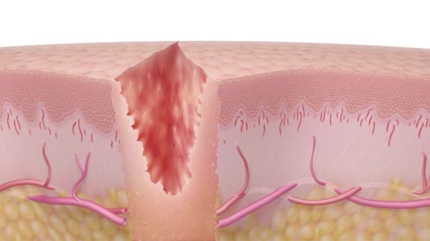 Zazwyczaj trwa około trzech tygodni dla drobnych ran, i to jest czas, kiedy ciało naprawia uszkodzone naczynia krwionośne i zastępuje uszkodzone tkanki zdrowe nowe. — Wideo stockowe