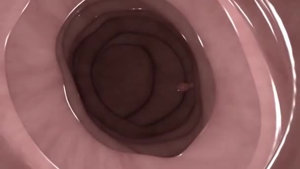 Risico op colonectale kanker, gevorderde adenomateuze poliepen gedetecteerd tijdens colonoscopie — Stockvideo