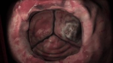 Kardiyak papiller fibroelastoma nadir de olsa iyi huylu kardiyak tümörlerin ikinci nedenidir.