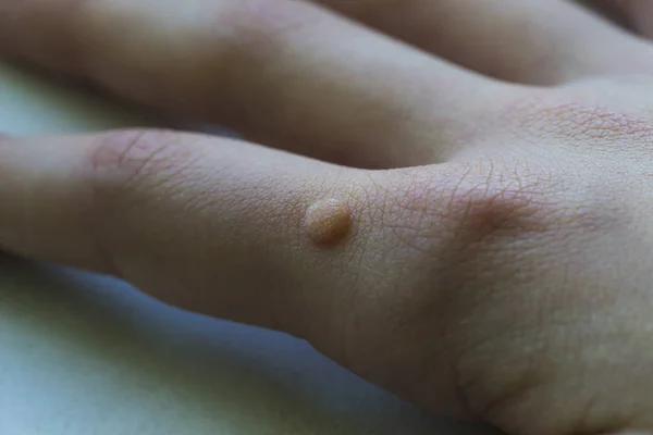 Ortak siğil (Verruca vulgaris) düz bir siğil genellikle t bulundu