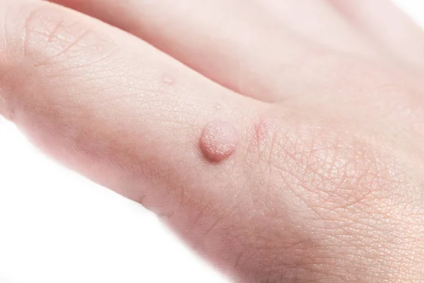 Common wart Verruca vulgaris a flat wart commonly found on the hand of children and adults. They are caused by a type of human papillomavirus HPV.