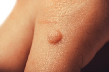 Verruca vulgaris yaygın olarak çocuklar ve yetişkinlerin elinde bulunan bir siğil. Bunlara bir çeşit insan papillomavirus HPV neden oluyor..