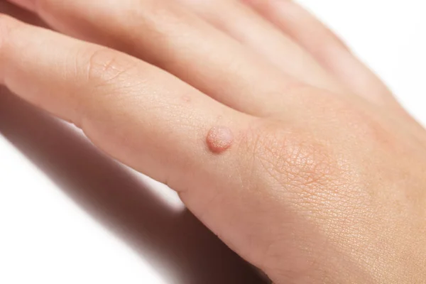 Verruca vulgaris yaygın olarak çocuklar ve yetişkinlerin elinde bulunan bir siğil. Bunlara bir çeşit insan papillomavirus HPV neden oluyor..