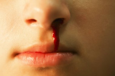 Bir kızın burnundan kan akıyordu. Sağlık ve tıbbi konsept. Yumuşak odak.