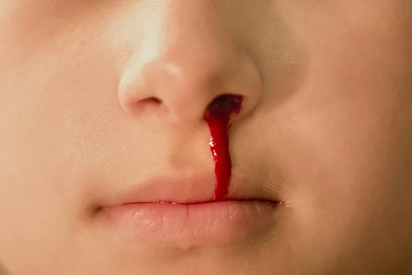 Epistaxis Nosebleed Young Woman Suffering Nose Bleeding Healthcare Medical Concept Stock Image