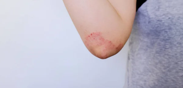 Dermatite Atopique Sur Articulation Coude Main Des Femmes Eczéma Allergies — Photo