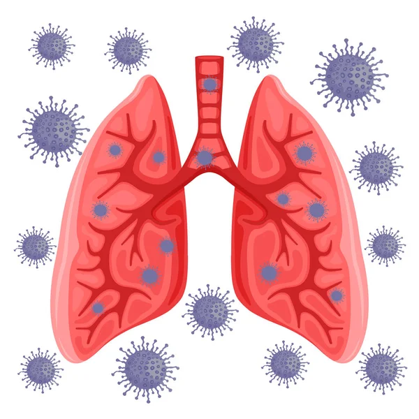 Pulmones Infectados Con Virus Sobre Fondo Blanco — Archivo Imágenes Vectoriales