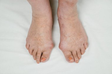 Gut hastalığı yüzünden deforme olmuş yaşlı bir kadının ayakları.