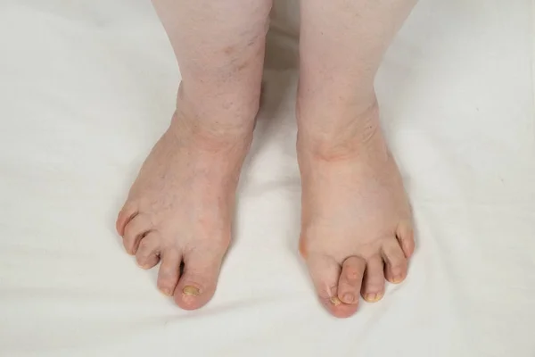Ноги Пожилой Женщины Ревматоидным Артритом Деформированная Ревматоидная Нога — стоковое фото