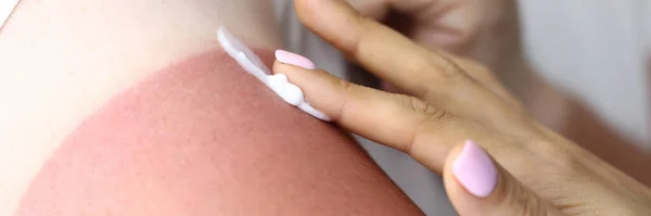 Vrouwen hand brengt crème aan om te verbranden om zonnebrand te behandelen. — Stockfoto