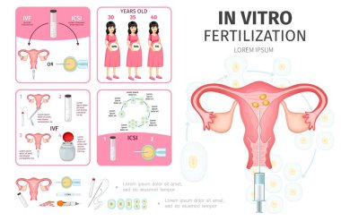 Daire in Vitro Fertilizasyon Infographic kavramında