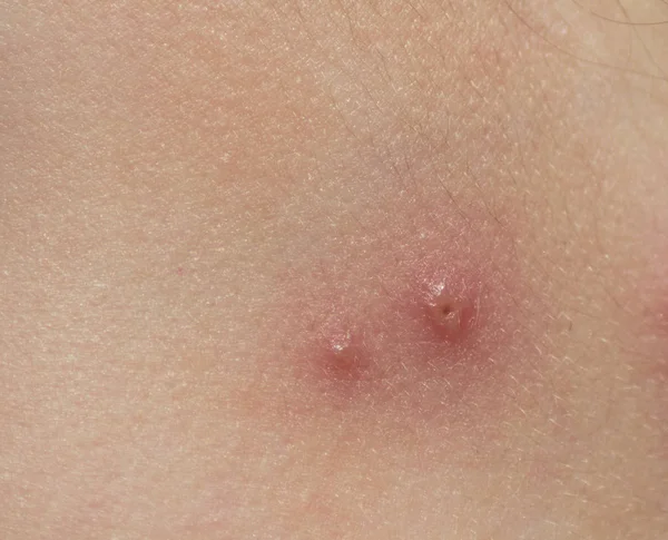 Chicken pox on child skin close up