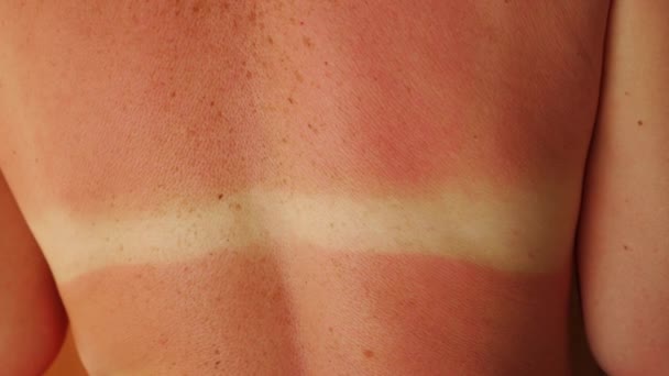 Sunburn Womans Back Result Sun Exposure Red Skin Burn — Stock Video