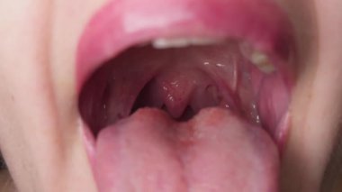 Close-up of an open mouth of a woman with an inflamed throat, tonsils, and tongue.