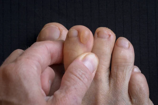 big callus on a woman's dirty foot, closeup photo of callus, feet surface injury