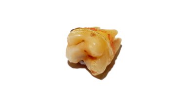 Beyaz arka plan üzerinde izole yakın çekim diş çürüğü