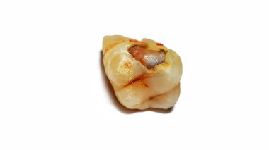 Beyaz arka plan üzerinde izole yakın çekim diş çürüğü