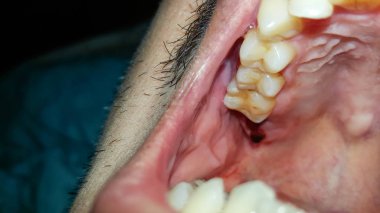 ağzına yakın çekim diş çürüğü