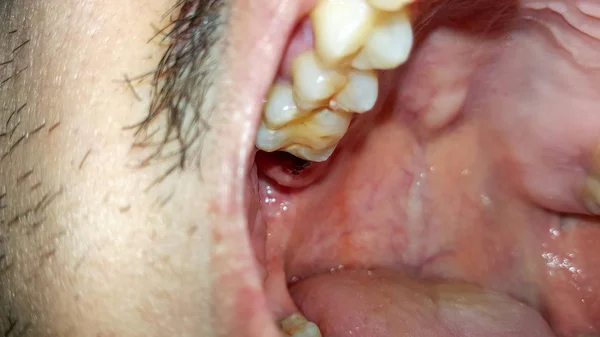 Ağzına Yakın Çekim Diş Çürüğü — Stok fotoğraf