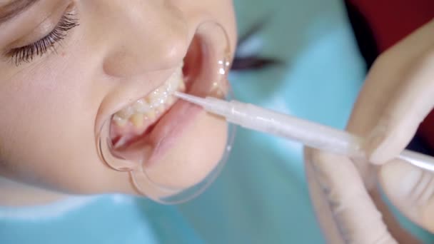 Dentista aplicar gel clareador dental para um paciente — Vídeo de Stock