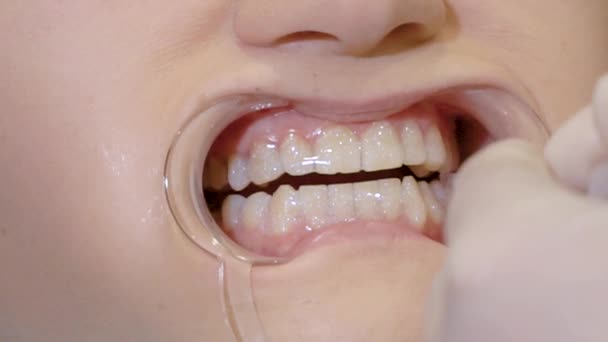 Close-up tandarts Breng tooth bleken gel aan op een patiënt — Stockvideo