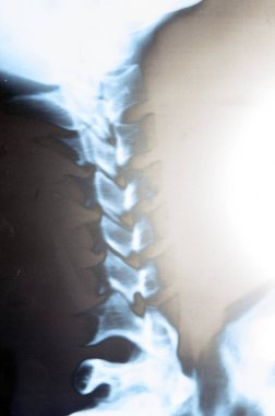eğrilik ve servikal omurga sorunlarının röntgeni.