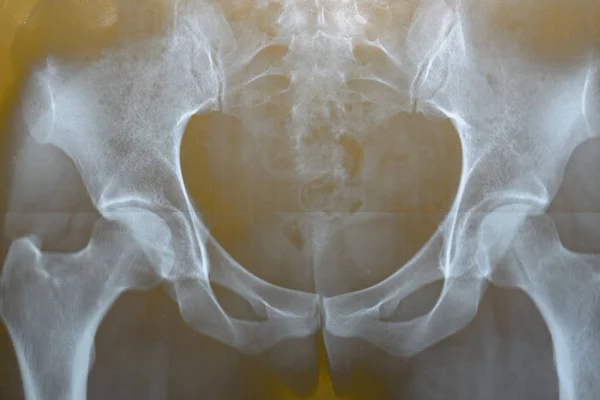 x-ray of the female hip joint, female problems, uterine and ovarian problems, arthritis and arthrosis of the joints.