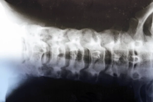 x-ray of curvature and cervical spine problems.