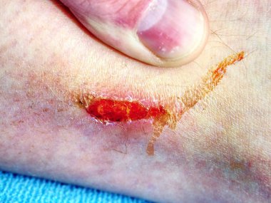 Spor kazadan sonra bacak üzerinde taze asalak detayını. Spor hastanın diz altında deri üzerinde ıslak kanlı aşınma.