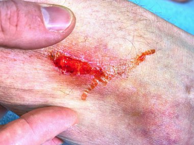 Cilt taze kanlı yerde. Kötü seyir bacak, detaylı atış çürük. Alçı içinde ambulancy kapsayan önce açık yara