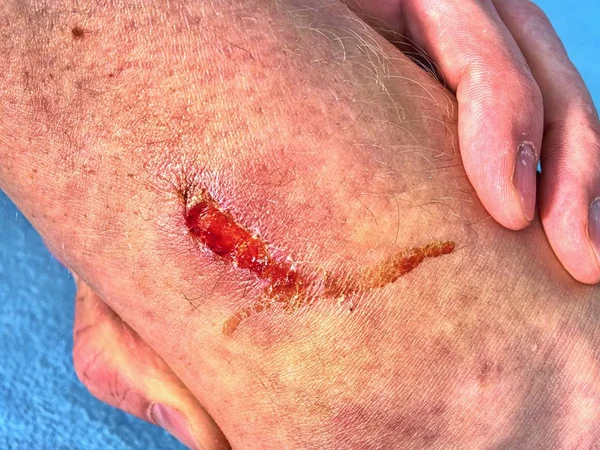 Detail Fresh Scab Leg Sport Accident Wet Bloody Abrasion Skin — Stock Photo, Image