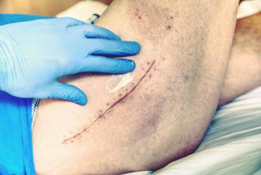 Eski insan bacak kalça eklemi cerrahisi ameliyat sonrası yara izi ile. Detay deri derin chirurgical ile kesti. Hastane sağlık bakım.