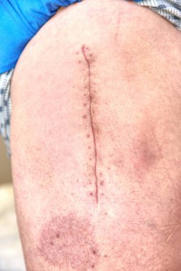 Harap kalça eklem kalça endoprotezde için değiştirme. Taze yara izi ile insan bacak seçici odak.