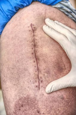 Taze bir uzun yara izi bir kalça ameliyat sonrası hastada. Makro, insan bacak kalça eklemi cerrahisi kanlı yara izi ile.