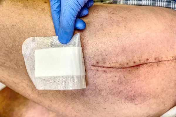Pierna Humana Vieja Con Cicatriz Postoperatoria Cirugía Articular Cadera Detalle — Foto de Stock