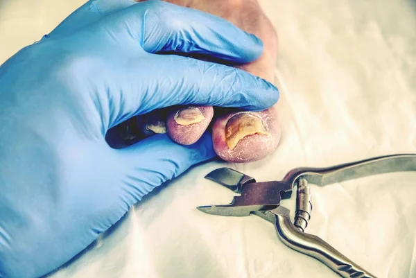 Manicurista Ospedaliero Con Pinze Pedicure Che Tagliano Unghia Del Piede — Foto Stock