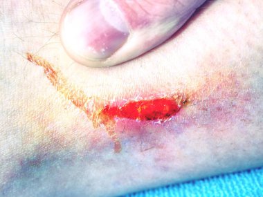 Cilt taze kanlı yerde. Kötü seyir bacak, detaylı atış çürük. Alçı içinde ambulancy kapsayan önce açık yara