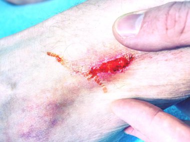 İlkyardım kanlı kırmızı nokta yara alan ile bacak yarası. Spor yaralanma ve sağlık kavramı. Kuru kan ile bacak yarası
