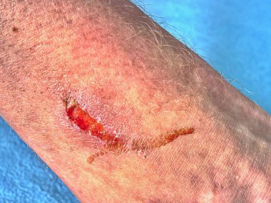 Bacağına bir trafik kazasından sonra yara. Yetişkin vücut zarar. Islak kanlı yer.