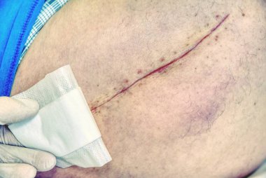 Taze bir uzun yara izi bir kalça ameliyat sonrası hastada. Makro, insan bacak 