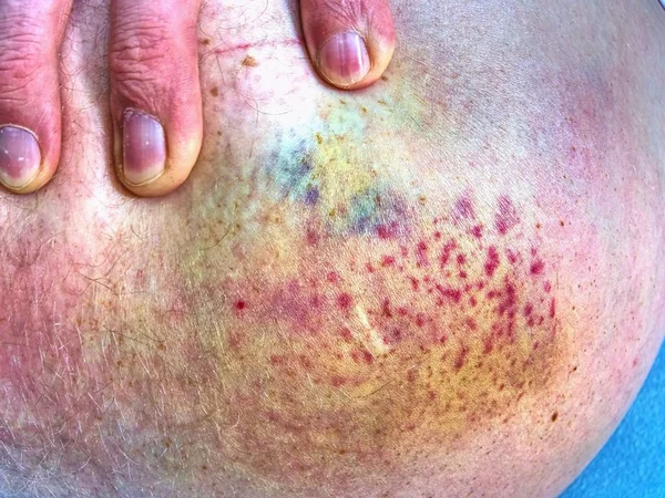 在病床上躺着受伤的男子腿部皮肤上的大瘀伤 男性腿上五颜六色的巨大瘀伤 — 图库照片